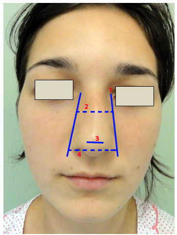 Figura 4. Dimensiunile piramidei nazale     1. LBN;      2. Lăţimea piramidei osoase (8);     3. Lăţimea lobulară nazală (9);      4. Lăţimea vârfului nazal (10).