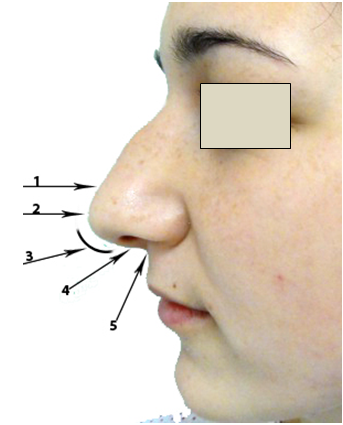 Figura 9. Structurile lobulului nazal                    (vedere laterală)     1. Supratip;      2. Tip;      3. Arc (baza alarelor);      4. Columela;      5. Baza columelei.