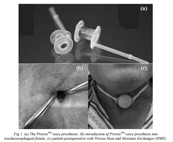 Protective effect of magnetic nanoparticles / salvia officinalis essential oil hibrid nanobiosystem againstfungal colonization on the provox® voice section prosthesis