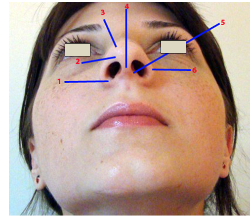 Figura 10. Structurile lobulului nazal (vedere bazală) 1.Baza alară; 2.Triunghiul moale; 3.Domul nazal; 4.Şanţul mediocolumelar; 5.Protuberanţa crus medial cartilaj alar; 6.Rama (marginea) alară.