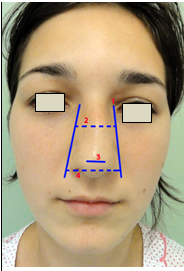 Figura 133. Vedere frontală. 1.Linia bazală a nasului (NBL); 2.Lăţimea piramidei osoase; 3.Lăţimea lobulului; 4.Lăţimea bazei alare.