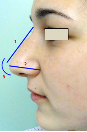 Figura 2. Dimensiunile piramidei nazale 1. Lungimea nasului (2); 2. Proiecţia vârfului (6); 3.Rotaţia vârfului (7).