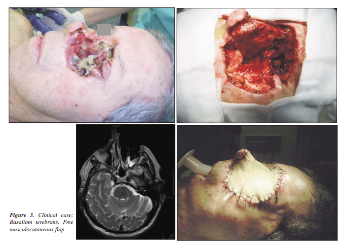 Reconstructive rhinoplasty in cases with basal cell carcinoma of the nose