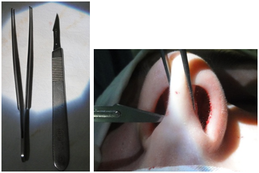 Figura 54. Instrumentele (pensa anatomică / bisturiu)  şi  incizia intersepto-columelară.