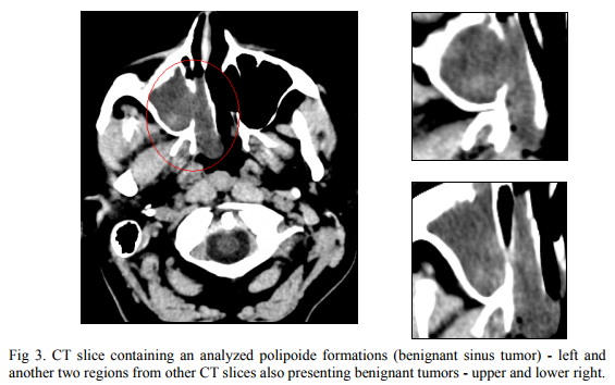 How relevant are the estimations of the fractal dimension of the texture and contourto discriminate between malignant and benignant sinus tumors – a statistical study