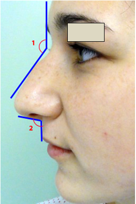 Figura 1. Unghiurile nasului. 1) Unghiul nazo-frontal 2) Unghiul nazo-labial.