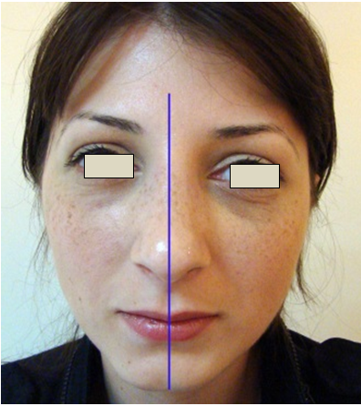 Figura 21. Linia mediană a feţei.