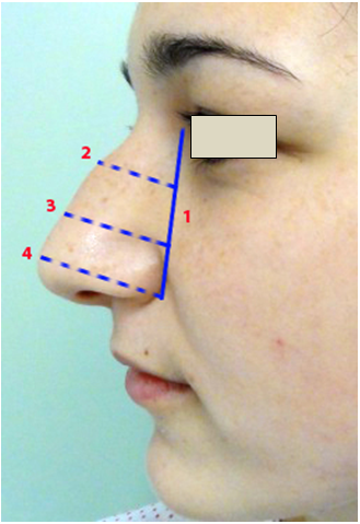 Figura 3. Dimensiunile piramidei nazale     1. Linia bazală a nasului (NBL);      2. Proiecţia osoasă (3);      3. Proiecţia cartilaginoasă (4);                    4. Proiecţia lobulului (5).