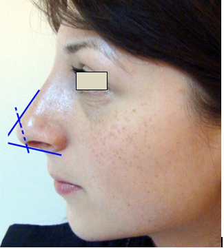Figura 31. Relaţia columelă - vârful nasului (dubla ruptură).
