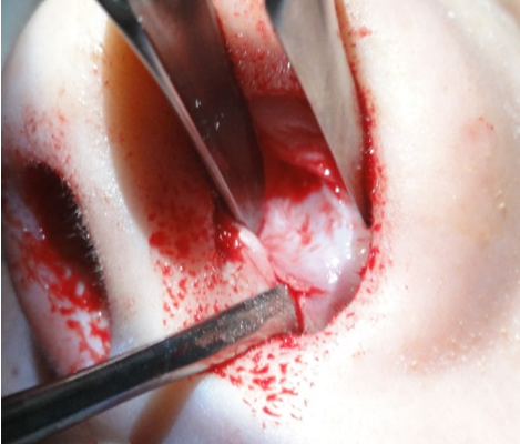 Figura 60. Decolarea contralaterală a crestei septale cartilaginoase.